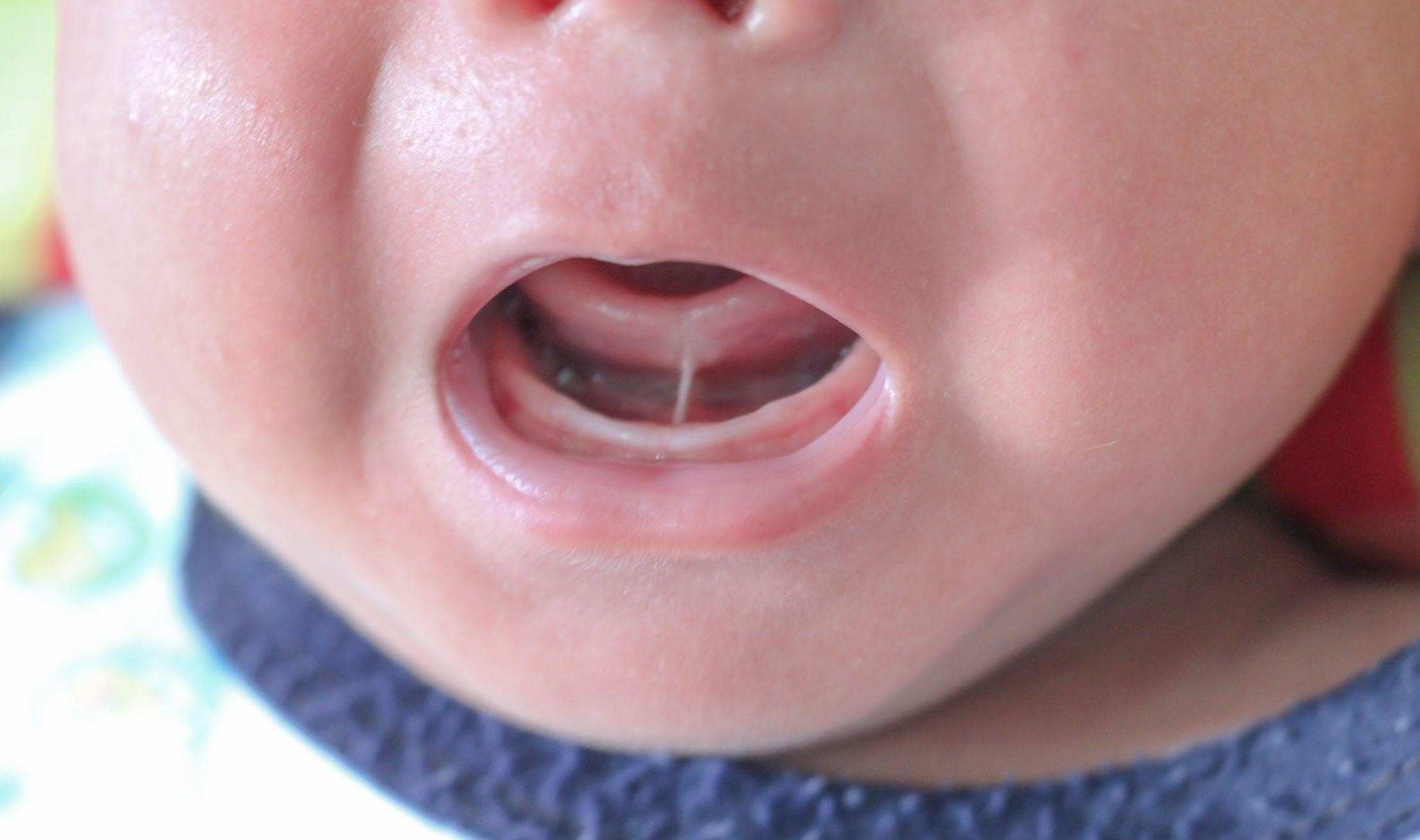Trẻ bị dính thắng lưỡi tùy vào mức độ để được chỉ định phẫu thuật